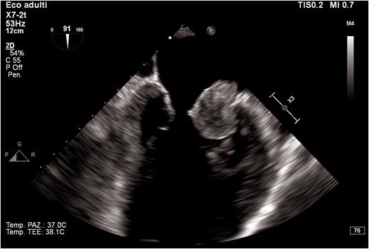 Transoesophageal echocardiogram mid-oesophageal view at 90° (two-chamber view). The figure shows the mass protruding in the left ventricle.