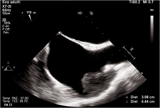 Transoesophageal echocardiogram mid-oesophageal view at 90° (bicaval view). The figure shows a mass in the right atrial appendage.