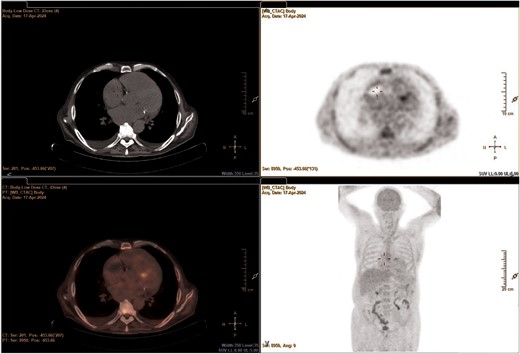Positron emission tomography/computed tomography scan focused on the heart.
