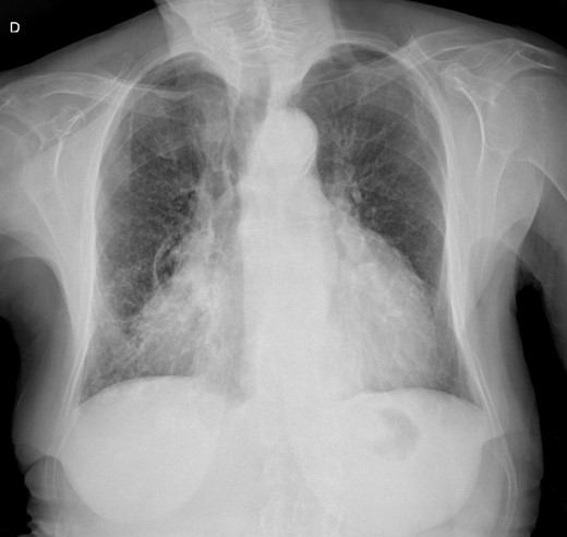 Initial chest X-ray.
