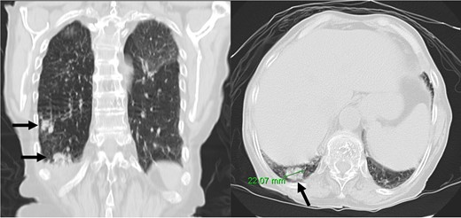 Nodular formations on thoracic computed tomography (arrows).