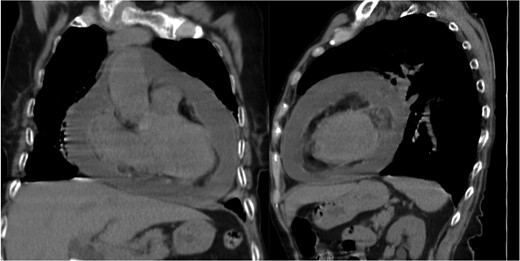 Pericardial effusion (thoracic computed tomography).