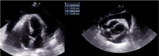 Pericardial effusion (transthoracic echocardiogram).