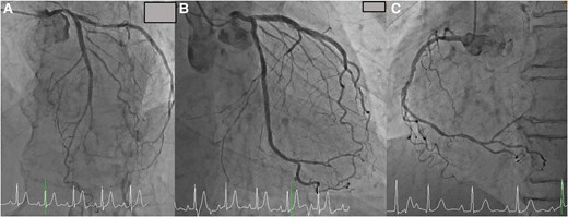 (A) Coronary angiogram showed no significant stenosis in the left anterior descending artery. (B) Coronary angiogram showed no significant stenosis in the circumflex artery. (C) Coronary angiogram showed no significant stenosis in the right coronary artery.