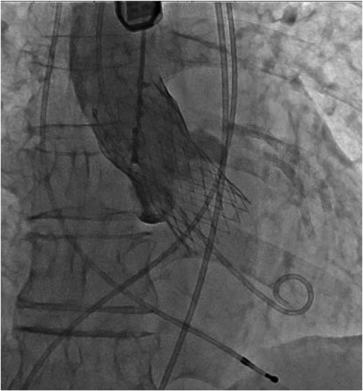 A 26-mm Evolut Pro Plus™ valve was implanted 9 mm below the annulus level.