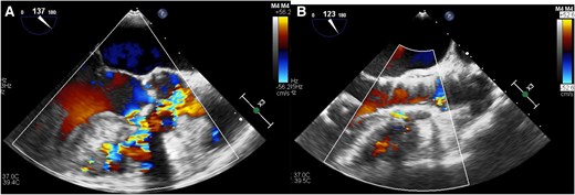 (A) Trans-oesophageal echocardiogram before trans-catheter aortic valve replacement revealed left-to-right shunt. (B) Trans-oesophageal echocardiogram after trans-catheter aortic valve replacement revealed the complete coverage of ventricular septal defect orifice by the valve and decreased left-to-right shunt without structural change of the left ventricular outflow tract and the left ventricle.