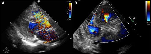 (A) Trans-thoracic echocardiogram before trans-catheter aortic valve replacement showing left-to-right shunt. (B) Trans-catheter aortic valve replacement showing decreased left-to-right shunt and good placement of the implanted valve.