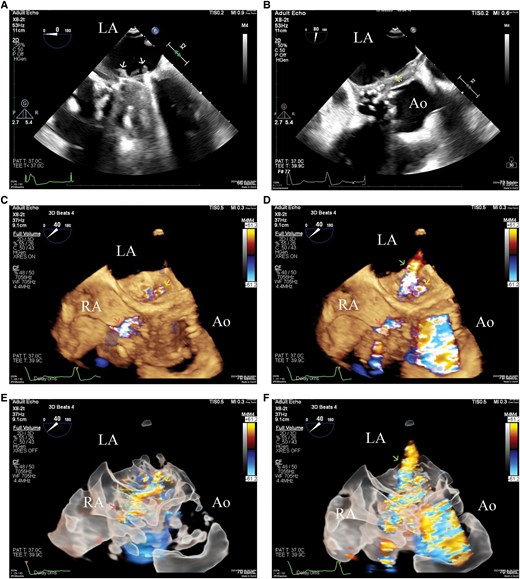 (A) 2D transoesophageal echocardiography showing vegetations (arrows) involving the prosthetic mitral valve in the four-chamber view. (B) 2D transoesophageal echocardiography showing echo-dense thickening (asterisk) of the aortic peri-valvular tissue. (C) 3D transoesophageal echocardiography with colour Doppler in the diastolic phase shows blood flow shunting of the aorto-cavitary fistulization into the left atrium (yellow arrow) and right atrium (red arrow). (D) 3D transoesophageal echocardiography with colour Doppler in the systolic phase shows a paravalvular leakage jet of the prosthetic mitral valve (green arrow), in addition to the blood flow shunting of the aorto-cavitary fistulization into the left atrium (yellow arrow) and right atrium (red arrow). (E) 3D glass view with colour Doppler in the diastolic phase delineates the continuity of the blood flow shunting into the left atrium (yellow arrow) and right atrium (red arrow). (F) 3D glass view with colour Doppler in the systolic phase shows a paravalvular leakage jet of the prosthetic mitral valve (green arrow), in addition to the aorto-cavitary fistulization.