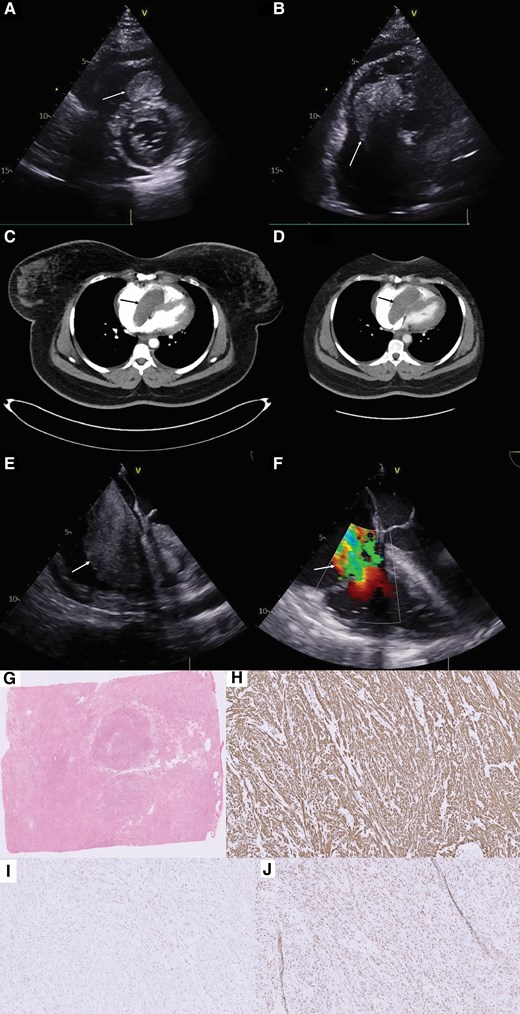 Bedside transthoracic echocardiogram (A and B), revealing the right-sided heart mass as the primary cause of patient’s presentation (arrows). CT with contrast (C and D), confirming the presence and site of the mass (arrows). Intraoperative transoesopageal echocardiogram showing the extension of mass from right atrium to right ventricle through the tricuspid valve (E), and severe tricuspid regurgitation after excision of the mass (F). Histopathology of the mass low power H&E (G), positive desmin (H), positive oestrogen receptors (I), and positive progesterone receptors (J), confirming that the mass is a leiomyoma.