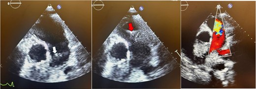 Parasternal short-axis echocardiogram with colour Doppler during the initial pulmonic valve infective endocarditis episode showing pulmonic valve vegetation during systole (white arrow), diastole (red arrow), and severe pulmonic regurgitation.