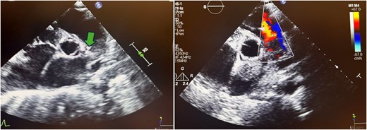 Parasternal short-axis echocardiogram with colour Doppler during the second pulmonic valve infective endocarditis episode showing vegetation on the arterial side of the pulmonic valve (arrow) and severe pulmonic regurgitation.