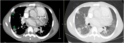 Computed tomography chest (axial slices) showing bilateral cavitary lung nodules (arrowheads) and ground glass opacities.