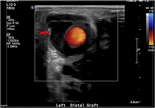 Ultrasonography of the graft site showing peri-graft fluid, ∼1.7 × 2.6 cm.
