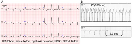 (A) 12-lead electrocardiogram showing sinus rhythm with a heart rate of 65 bpm, right axis deviation, and right bundle branch block with a QRS duration of 170 ms. (B) Atrial tachycardia at 200 bpm (top panel) and a sinus arrest of 3.3 s (bottom panel) recorded using a 14-day electrocardiography patch monitor. AT, atrial tachycardia; QRSd, QRS duration; RBBB, right bundle branch block.