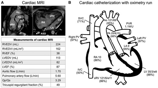 (A) Cardiac magnetic resonance imaging showing the aorta arising from the enlarged systemic right ventricle, the pulmonary artery originating from the left ventricle, and a large secundum atrial septal defect. The lower table summarizes the measurements. (B) Intracardiac pressure (upper panel, mmHg) and oxygen saturation (lower panel, %) data obtained using cardiac catheterization. ASD, atrial septal defect; Ao, aorta; IVC, inferior vena cava; LA, left atrium; LV, left ventricle; LVEDV, left ventricular end-diastolic volume; LVEDVI, left ventricular end-diastolic volume index; LVEF, left ventricular ejection fraction; MRI, magnetic resonance imaging; PA, pulmonary artery; PV, pulmonary vein; PVR, pulmonary vascular resistance; Qp/Qs, pulmonary-to-systemic flow ratio; RA, right atrium; RVEDV, right ventricular end-diastolic volume; RVEDVI, right ventricular end-diastolic volume index; RVEF, right ventricular ejection fraction; sRV, systemic right ventricle; SVC, superior vena cava; WU, Wood units.