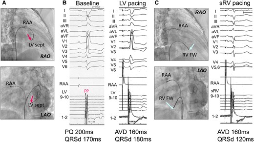 Data obtained from the pacing study prior to pacemaker implantation. (A) Electrode catheter placed at the left ventricular septum via the atrial septal defect (red arrows). (B) Although a Purkinje potential was recorded at the left ventricular septal pacing site, indicating that the conduction system was being captured, left ventricular pacing unexpectedly resulted in a prolonged QRS duration. (C) Electrode catheter placed at the systemic right ventricle-free wall (light blue arrows), showing a shortened QRS duration during systemic right ventricle pacing. AVD, atrioventricular delay; FW, free wall; LAO, left anterior oblique; LV, left ventricular; PP, Purkinje potential; QRSd, QRS duration; RAA, right atrial appendage; RAO, right anterior oblique; sRV, systemic right ventricle.