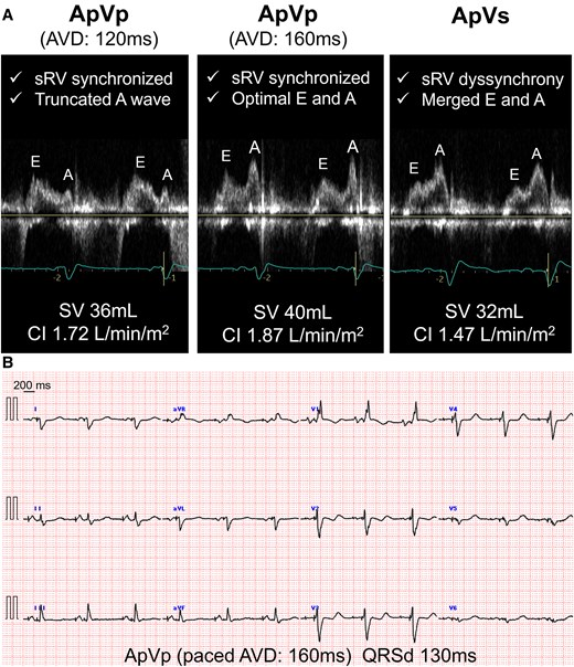 (A) Optimization of atrioventricular delay using non-invasive electrical cardiometry and echocardiography. Systemic right ventricular synchrony, transmitral flow patterns, stroke volume, and cardiac index were assessed during atrioventricular delay adjustments in DDD mode at 70 bpm and delays of 120 ms (ApVp), 160 ms (ApVp), and 300 ms (ApVs). The optimal atrioventricular delay was 160 ms. (B) The final setting at an atrioventricular delay of 160 ms resulted in a narrowed QRS duration of 130 ms on 12-lead electrocardiography. AVD, atrioventricular delay; CI, cardiac index; QRSd, QRS duration; sRV, systemic right ventricle; SV, stroke volume.