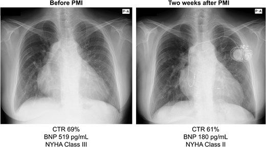 Chest radiographs obtained before and after pacemaker implantation indicate a reduction in the cardiothoracic ratio, along with a decrease in brain natriuretic peptide levels and improvement in NYHA classification. BNP, brain natriuretic peptide; CTR, cardiothoracic ratio; NYHA, New York Heart Association.