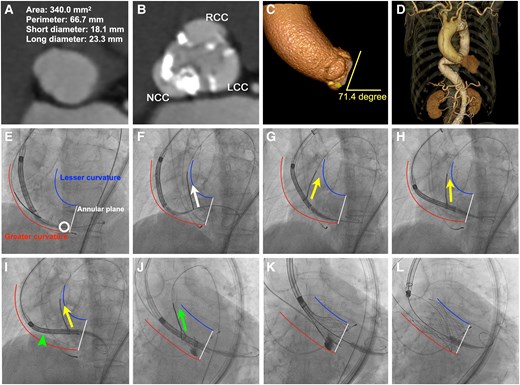 Snare-assisted delivery and coaxial optimization. (A–D) Pre-procedural computed tomography demonstrates severe calcification, particularly in the non-coronary cusp (NCC), along with an extremely horizontal ascending aorta (aortic root angle: 71.4°) and a tortuous descending aorta. (E) Bioprosthesis failed to cross the aortic valve because of extensive NCC calcification (white circle). (F) The nose cone was initially snared but failed to cross the aortic valve (white arrow). (G–I) Snare engagement at the lower third of the delivery capsule facilitated valve advancement (yellow arrows); however, non-coaxial alignment was observed (green arrowhead). (J, K) Snare engagement at the upper third of the capsule achieved proper coaxial alignment (green arrow). (L) Final result. White line: annular plane. Blue line: lesser curvature of the ascending aorta. Red line: greater curvature of the ascending aorta.