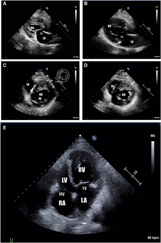 Echocardiogram findings: consistent with congenitally corrected transposition of the great arteries (levo-transposition of the great arteries). Systemic ventricle (morphologically right ventricle) is receiving blood via tricuspid valve and pump it through the aortic valve, which is located anterior to the PV. Systemic ventricle is mildly dilated and heavily trabeculated with mild to moderate global hypokinesis and mildly reduced systolic function (ejection fraction 45%–50%). There is mild tricuspid regurgitation. (A) Pre-catheterization parasternal long-axis view. (B) Post-catheterization parasternal long-axis view. (C) Pre-catheterization short-axis mid-ventricular view. (D) Post-catheterization short-axis mid-ventricular view. (E) Post-catheterization apical four-chamber view. Note: AFib. AV, aortic valve; LA, left atrium; LV, left ventricle; MV, mitral valve; RA, right atrium; RV, right ventricle; TV, tricuspid valve.