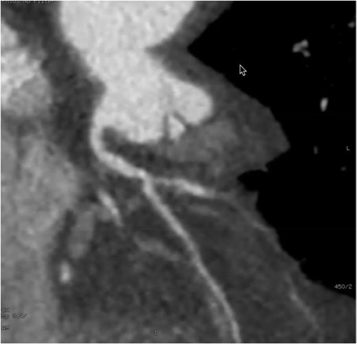 Cardiac computed tomography findings: the right facing cusp gives rise right coronary artery; the proximal segment prior to its bifurcation has moderate to severe coronary artery disease. Coronary artery calcium score is 100.
