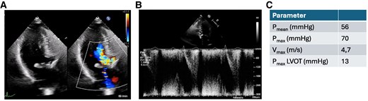 Transthoracic echocardiography before transcatheter aortic valve implantation treatment. (A) Apical three-chamber view of the aortic valve in systole showing severe flow acceleration and (B) pulse wave Doppler in the left ventricular outflow tract. (C) Doppler over the aortic valve.