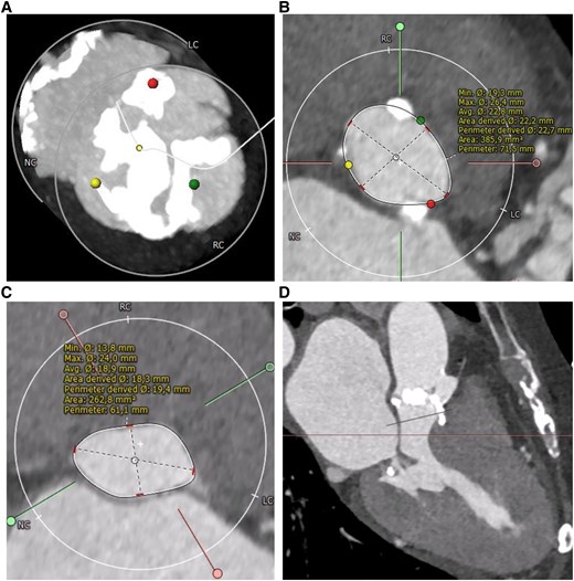 Pre-operative end-systolic computed tomography of the heart. (A) Computed tomography scan of the aortic valve shows severe calcification. (B) Annular assessment. (C) Assessment of the left ventricular outflow tract (LVOT) 8.5 mm below annular plane. (D) Left heart section showing left ventricular hypertrophy and small left ventricular chamber.