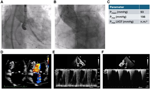 Transcatheter aortic valve implantation procedure and post-operative echocardiography. (A) Release of a self-expanding valve (Evolut Fx 26 mm, Medtronic, Minneapolis, MN, USA). (B) Transcatheter aortic valve implantation prosthesis after implantation without relevant aortic regurgitation. (C) Quantitative parameters in transthoracic echocardiography. *Pmax in the left ventricular outflow tract was not measurable by PW-Doppler (see Pmax by CW-Doppler). (D) Post-operative transthoracic echocardiography shows severe mitral regurgitation (D) and high left ventricular outflow tract gradients (E and F).