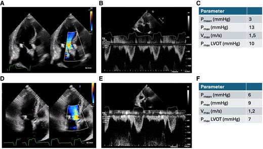 Apical three-chamber view, pulse wave Doppler in the left ventricular outflow tract and Doppler over the aortic valve 10 days after transcatheter aortic valve implantation (A–C) and 9 weeks after transcatheter aortic valve implantation (D–F).