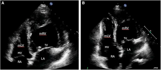 Transthoracic echocardiographic findings of a 42-year-old woman after OHCA. The right ventricle shows predominant apical trabeculation and the presence of a moderator band (A). Additionally, the apically displaced tricuspid AV valve is displayed (B). LA, left atrium; mLV, morphologic left ventricle; mRV, morphologic right ventricle; MV, mitral valve; RA, right atrium; TV, tricuspid systemic AV valve.