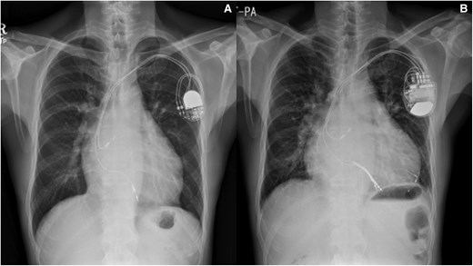 Chest radiography of a 57-year-old male patient with ccTGA, post-implantation of a dual-chamber PPM for complete heart block with mild cardiomegaly (A) and worsening sRV failure over time (B) despite upgrade to CRT.