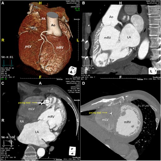 Cardiac CT of a 57-year old male patient confirming the diagnosis of ccTGA. (A): 3D-anatomical reconstruction revealing L-transposition of the great arteries with the aorta in left anterior position arising from the systemic morphologic right ventricle. (B): CT 3-chamber view revealing progressive RA- and RV-dilation with a sRV in sub-aortic position and a tricuspid atrioventricular valve. (C): CT 4-chamber view revealing RA- and RV-dilation as well as the pacemaker-wire in the apical subpulmonary LV. (D): CT short axis view at the papillary muscle level revealing the left sided and dilated systemic RV in leftward position. Ao, Aorta; LA, left atrium; mLV, morphologic left ventricle; mRV, morphologic right ventricle; PA, pulmonary artery; RA, right atrium.