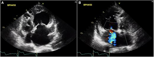 Transthoracic echocardiography of a 57-year-old male patient with ccTGA. (A): apical four-chamber-view revealing the systemic RV with a hyper trabeculated apex in leftward position with accompanying moderate regurgitation of the systemic tricuspid atrioventricular valve in the apical two-chamber view (B).