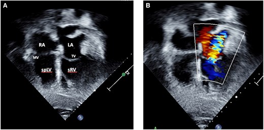 Transthoracic echocardiography of a 63-year-old male presenting with ACS and incidental findings of (A) atrio-ventricular and ventriculo-arterial discordance in the setting of ccTGA with pulmonary stenosis, VSD as well as moderate regurgitation of the systemic AV-valve (B). LA, left atrium; MV, mitral valve; spLV, sub pulmonary left ventricle; sRV, systemic right ventricle, TV, tricuspid valve.