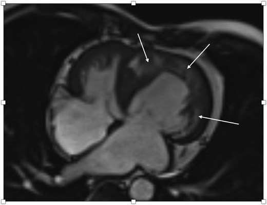 Cardiac MRI of a 63-year-old male with ACS after PCI showing impaired sRV function as well as subendocardial and transmural oedema in the sRV wall as well as the interventricular septum (arrows) correlating with an acute NSTEMI due to severe stenosis of the middle RCA and a CTO of both the left circumflex artery and the distal RCA.