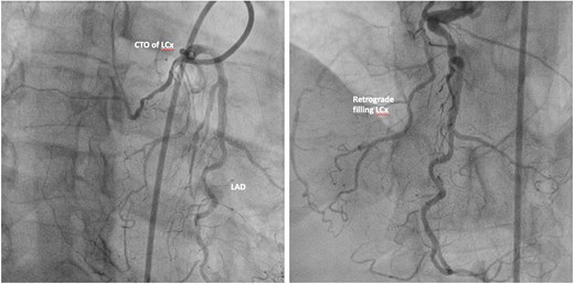 Coronary angiogram of a 63-year-old-male presenting with ACS. LCA from the right coronary cusp revealing CTO of the left circumflex artery with retrograde filling. CTO, chronic total occlusion; LAD, left anterior descending artery; LCx, left circumflex artery.