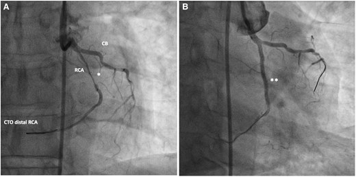 Coronary angiogram of a 63-year-old male presenting with ACS. RCA from the left coronary cusp revealing severe stenosis of the mid-RCA (A) and CTO of the distal RCA. (B) Post-interventional angiogram after PCI of the mid-RCA with a good interventional result with remaining CTO of the distal RCA after unsuccessful interventional attempts. CB, Conal branch; CTO, chronic total occlusion; *, severe stenosis of mid-RCA; **, post-stenting of mid-RCA.