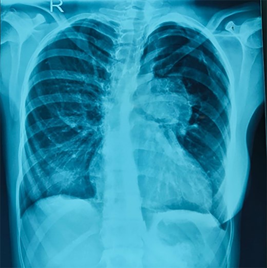 Chest X-ray on admission showing cardiomegaly and aneurysmal dilatation of pulmonary arteries.