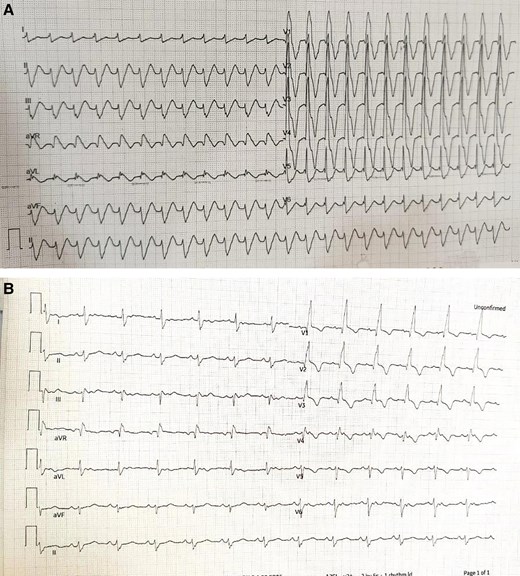 (A) Event electrocardiogram (ECG) showing q right bundle branch block (qRBBB) with QRS duration 180 ms and deep T wave inversion in anterior chest leads. (B) Immediate post-operative ECG, showing sinus rhythm with RBBB with QRS duration 120 ms.