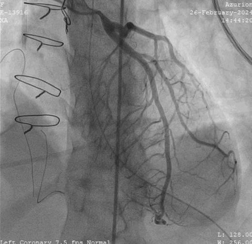 Invasive coronary angiogram in left anterior oblique cranial view showing narrowed left main coronary artery ostium with no coronary artery disease.