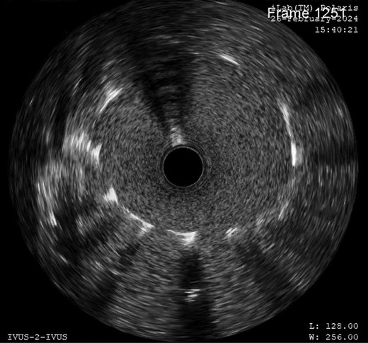 Post-stenting intravascular ultrasound showed covered ostium and well-expanded stent without any recoil.