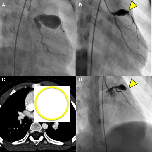 Course of coronary artery aneurysm in this case. Giant coronary aneurysm in Segment 1 and 6 (A). Coronary aneurysm in Segment 6 two years after onset (B, C). Coronary aneurysm in Segment 6 three years after onset (D).