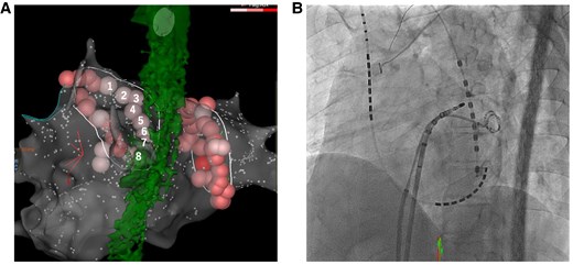 (A) Eight ablation lesions at the posterior aspect of the left pulmonary vein and the oesophagus is shown. (B) The positional relationship between the oesophageal temperature probe and the ablation catheter during ablation of the posterior aspect of the left pulmonary vein is shown.