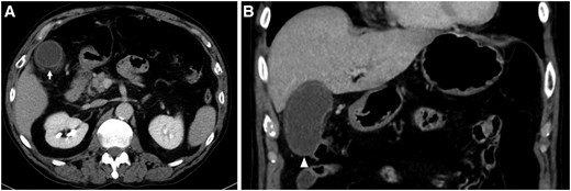 (A) Gallbladder wall thickening and subserosal oedema are shown (arrow). (B) Gallbladder enlargement without a gallbladder stone is shown (arrowhead).