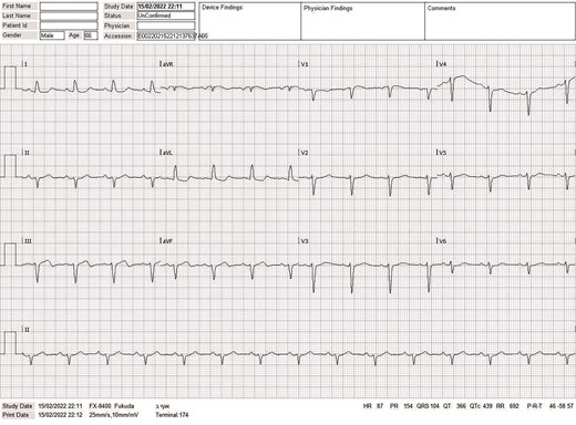 ECG at presentation in the emergency room, showing sinus rhythm with mild inconclusive ST segment changes in inferior and high lateral leads.