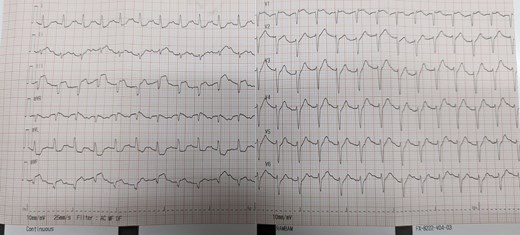 Second ECG at internal medicine department revealing new ST segment elevation in the inferior leads (II-III-AVF).