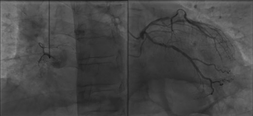 Coronary angiography demonstrating chronic total occlusion of the RCA (left side) and lesions of the LAD and LCX (right side).