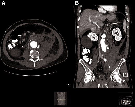 Abdominal CT showing a large infrarenal aortic aneurysm with mural thrombus and contrast extravasation through the posterior wall with extensive retroperitoneal haemorrhage.