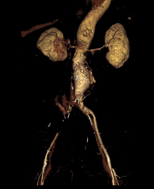3D reconstruction demonstrating aneurismatic aorta. Right common iliac artery was obstructed by thrombus.