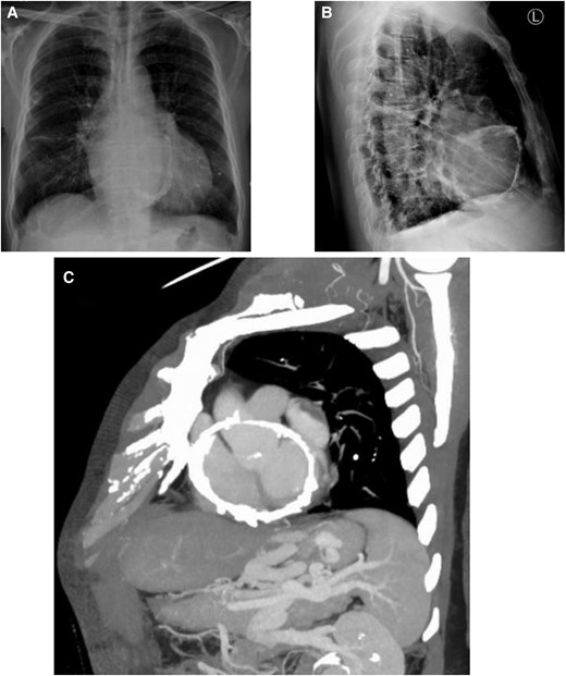 (A, B) Posteroanterior and lateral chest radiographs demonstrate an oval-shaped annular calcification adjacent to the atrioventricular groove, accompanied by pleural effusion and pulmonary oedema. (C) Contrast-enhanced chest CT reveals an oval-shaped calcification along the atrioventricular groove with localized eggshell-like hyperdensity. Note the dilated inferior vena cava and portal vein, along with multiple tortuous and engorged collateral vessels in the hepatogastric space and gastric fundus.